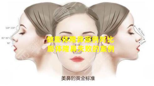 做膨体隆鼻案例对比 膨体隆鼻失败的案例